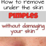 How to Remove Under the Skin Pimples Without Damaging Your Skin