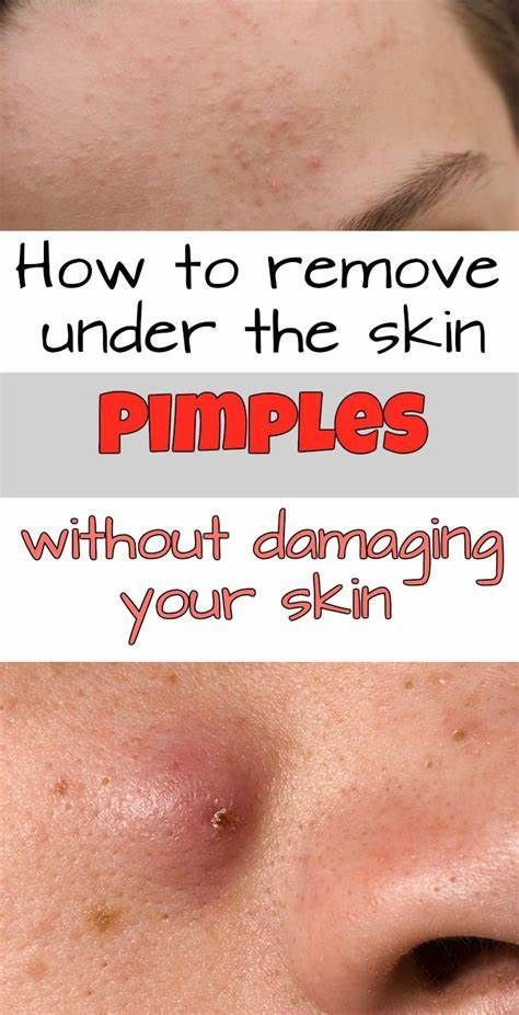 How to Remove Under the Skin Pimples Without Damaging Your Skin