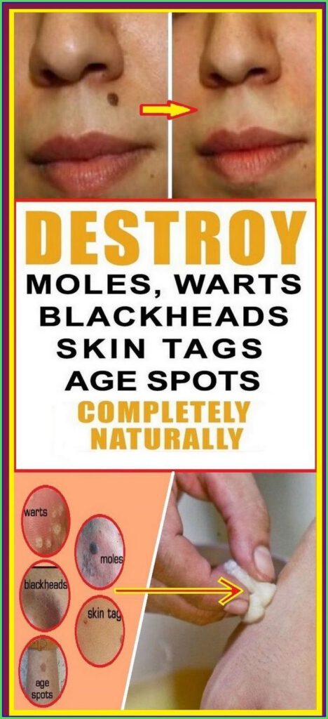 Destroy Your Moles, Warts, Blackheads, Skin Tags and Age Spots Completely Naturally