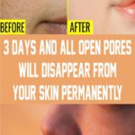3 Days and All Open Pores Will Disappear from Your Skin Permanently