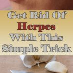 Get Rid of Herpes By Using a Simple Trick