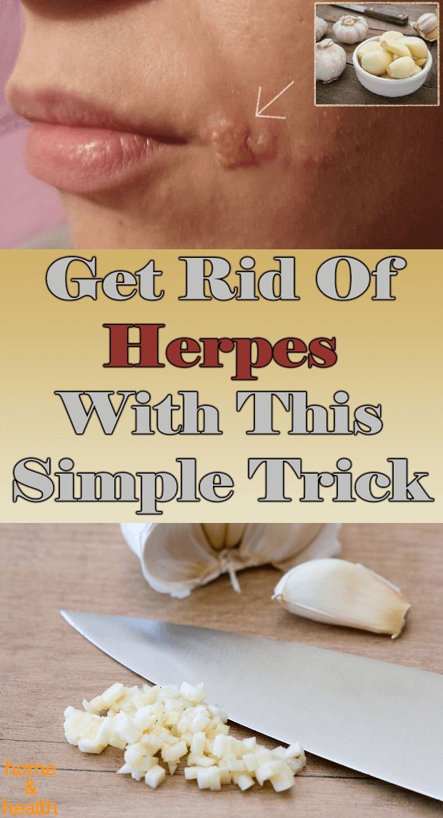 Get Rid of Herpes By Using a Simple Trick