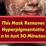 No More Hyperpigmentation, Dark Spots and Stains: This Mask Removes All Them!