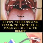 Tips On Removing Tonsil Stones With Relief!