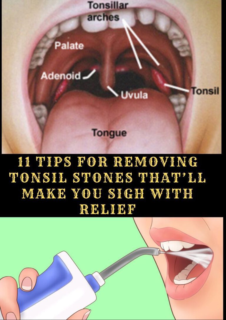 Tips On Removing Tonsil Stones With Relief! Healthy