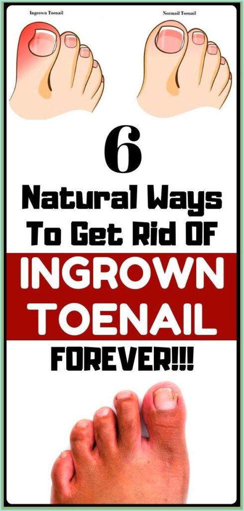 Treat Your Ingrown Toenail With These 6 Natural & Homemade Remedies ...