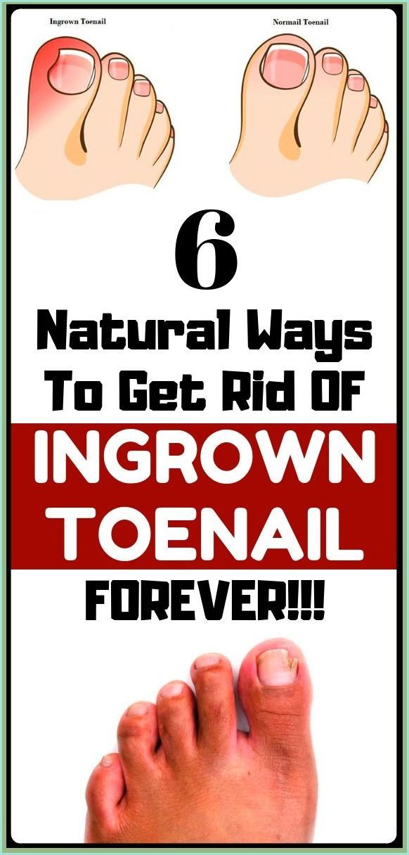 Treat Your Ingrown Toenail With These 6 Natural & Homemade Remedies