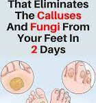 Home Remedy That Eliminates The Calluses and Fungi From Your Feet In 2 Days