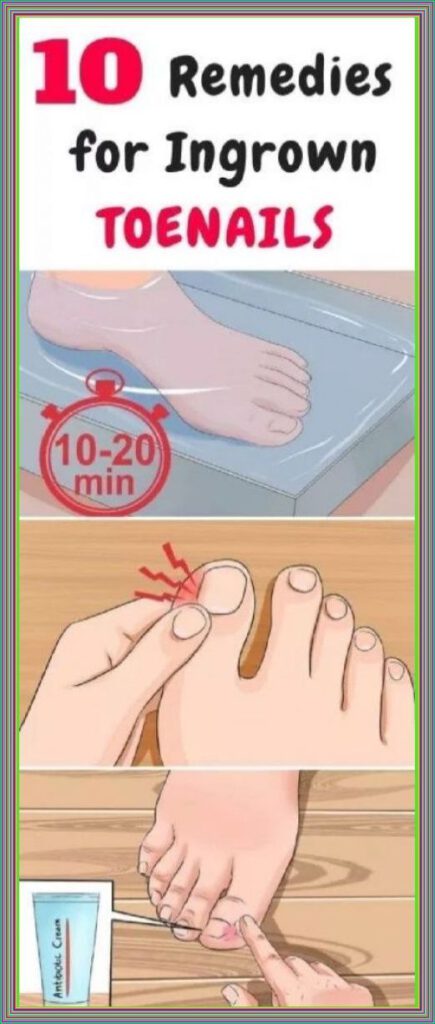 10 Remedies For Ingrown Toenails Healthy 8641